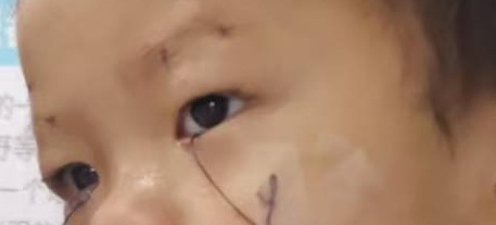 上瞼下垂